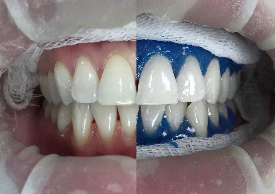 Профессиональное отбеливание зубов, фото до и после